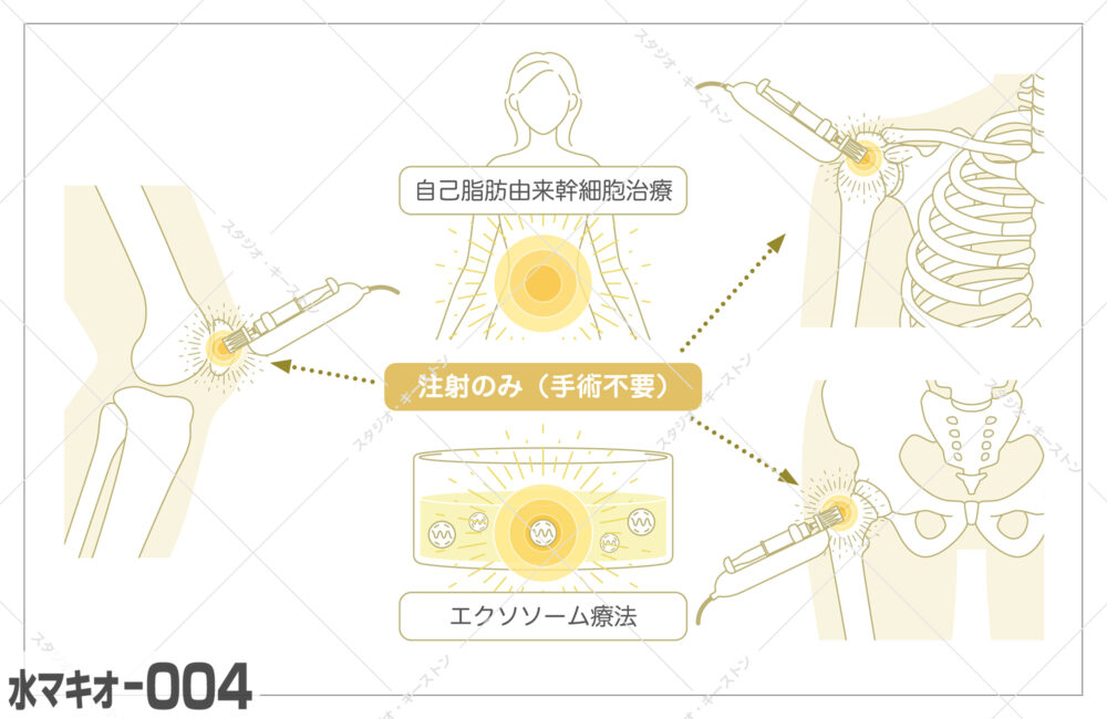 自己脂肪由来幹細胞治療とエクソソーム療法を解説した医療用イラスト。手術不要で関節へ注射する仕組みを分かりやすく図解した説明用のイラストです。
